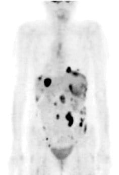 Figure 1: SM's PET-Scan taken in January 2007