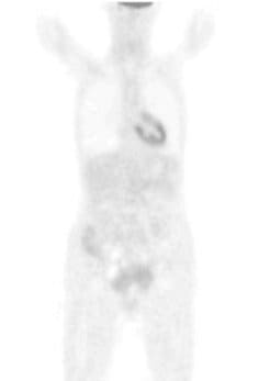 Figure 2: SM after treatment at St. George Hospital