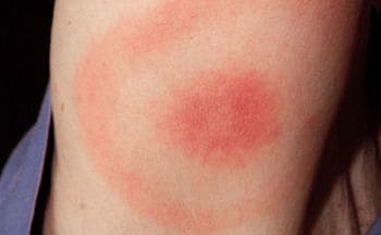 Erythema migrans, typische Hauterscheinung der akuten Borreliose